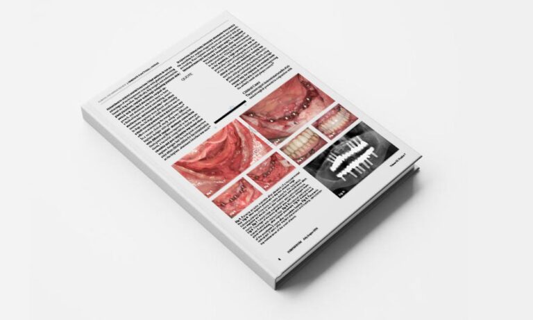 Advanced Immediate Functional Loading: Requirements for Long-Term Success in Modern Implant Dentistry