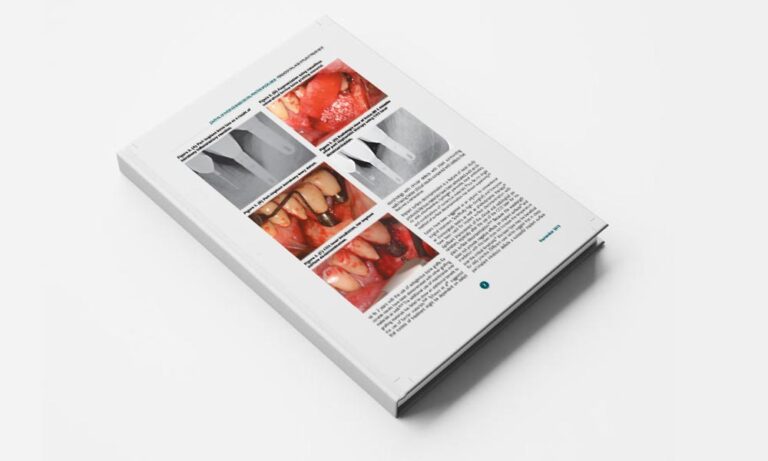 Therapy of Peri implant Diseases