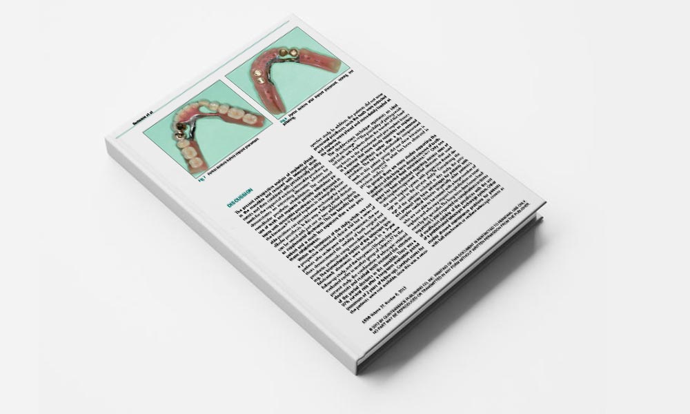 Immediate Loading of Tooth-Implant–Supported Telescopic Mandibular Prostheses