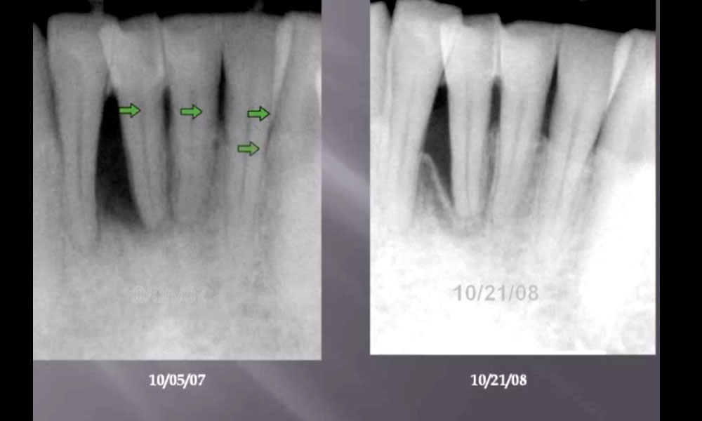 LANAP Laser Periodontist lecture Before and After Gum Surgery