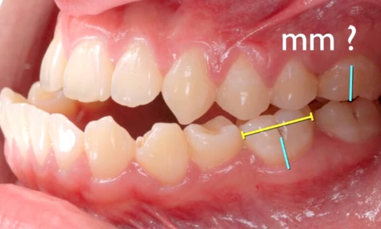 Amazing Class III Open Bite