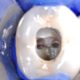 Mandibular Molar with 5 Root Canals