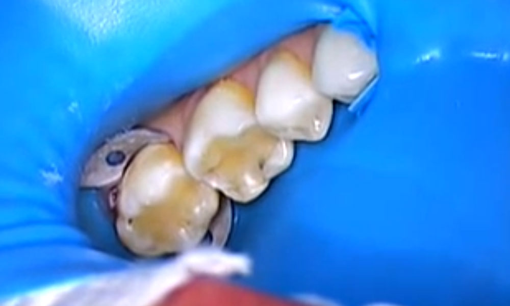 Replacing old dental fillings with cosmetic crowns