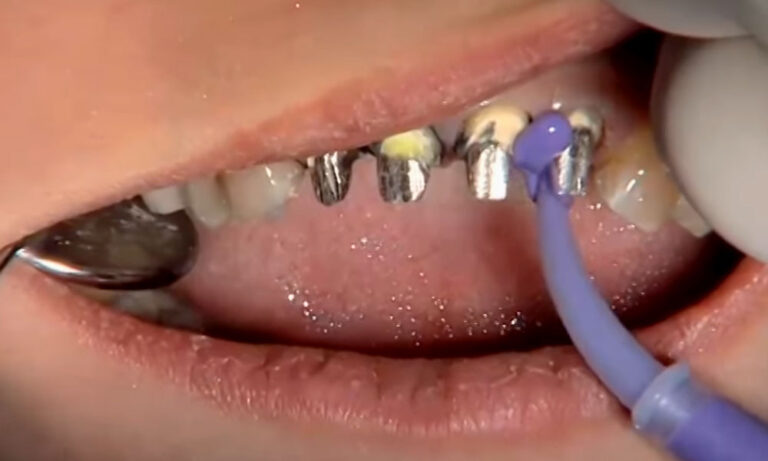 IPS e max CAD Clinical Advantages & Procedures