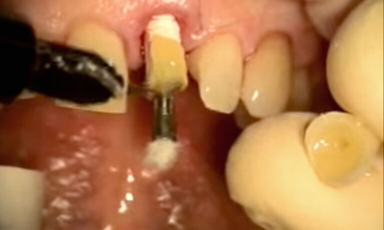 Implant Microsurgery