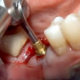 Molar Extraction and Immediate Implant Placement