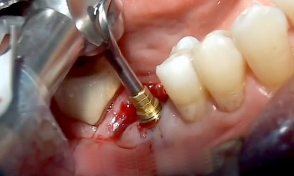 Molar Extraction and Immediate Implant Placement