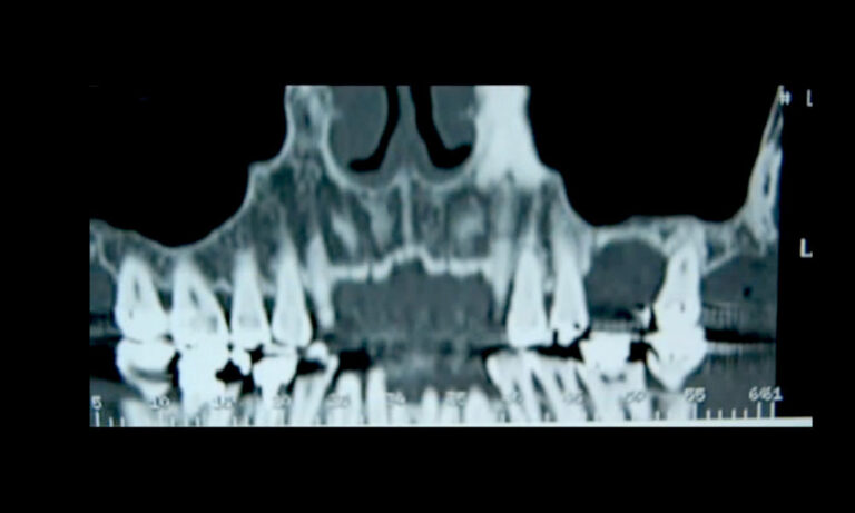 Sinus Lift (implantology)