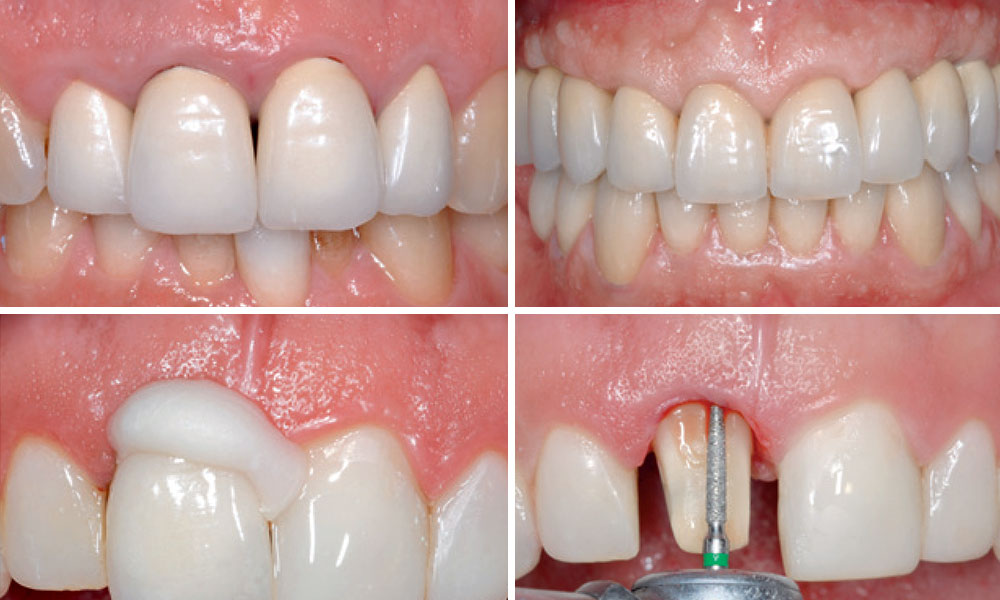 How to achieve a stable esthetic results with implant supported restorations