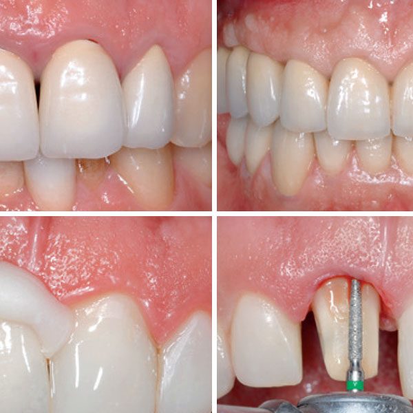 How to achieve a stable esthetic results with implant supported restorations